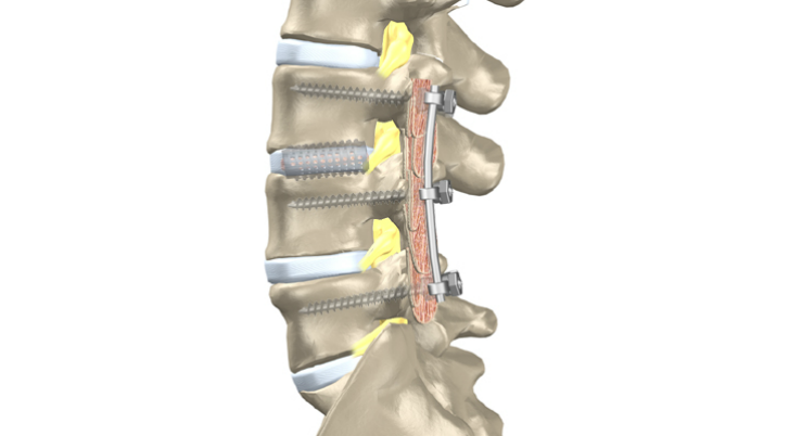 lumbar_decompression